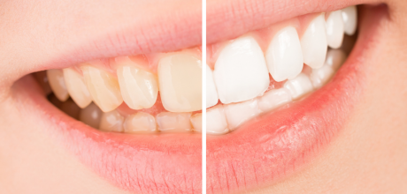 Branqueamento Dentário – tudo o que precisa saber