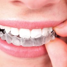 Invisalign: Conheça o aparelho dentário invisível